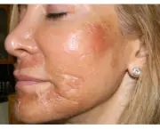 Benefícios do Peeling Facial (11)