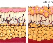 diagrama-celulite