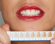 duvidas-comuns-sobre-clareamento-dentario (2)
