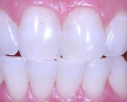duvidas-comuns-sobre-clareamento-dentario (3)