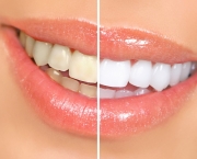 duvidas-comuns-sobre-clareamento-dentario (4)
