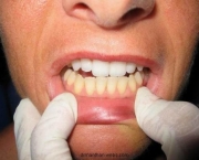 duvidas-comuns-sobre-clareamento-dentario (7)