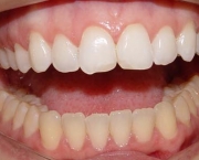 duvidas-comuns-sobre-clareamento-dentario (9)