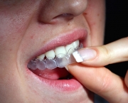 duvidas-comuns-sobre-clareamento-dentario (12)