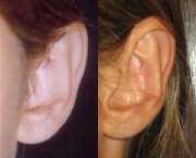 otoplastia-cirurgia-da-orelha (11)
