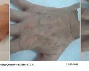 Peeling das Mãos (1)