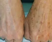 Peeling das Mãos (7)