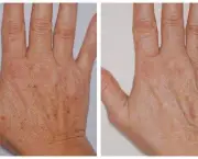 Peeling das Mãos (11)