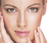 Benefícios do Peeling Facial (10)