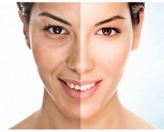 Benefícios do Peeling Facial (14)