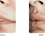 aumento-dos-labios (4)