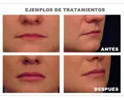 aumento-dos-labios (6)