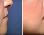 aumento-dos-labios (7)