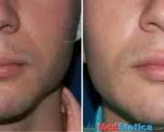 aumento-dos-labios (10)