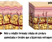 celulite1