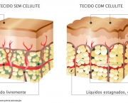 celulite3