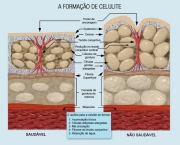 formacao_de_celulite