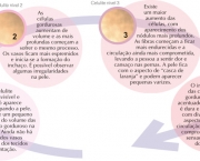 celulite graus