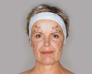 Cirurgia Plástica Facial (16)