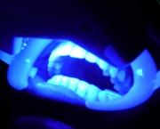 como-funciona-o-clareamento-dental-a-laser (2)