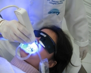 como-funciona-o-clareamento-dental-a-laser (3)