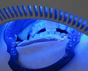 como-funciona-o-clareamento-dental-a-laser (5)