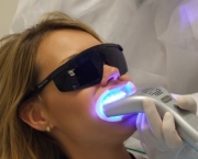 como-funciona-o-clareamento-dental-a-laser (6)