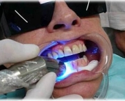 como-funciona-o-clareamento-dental-a-laser (7)