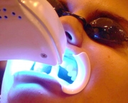 como-funciona-o-clareamento-dental-a-laser (8)