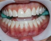 como-funciona-o-clareamento-dental-a-laser (10)