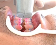como-funciona-o-clareamento-dental-a-laser (13)