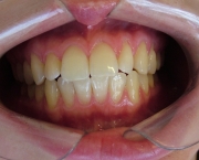 como-funciona-o-clareamento-dental-a-laser (15)