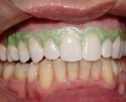 como-funciona-o-clareamento-dental-a-laser (16)