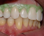 como-funciona-o-clareamento-dental-a-laser (18)