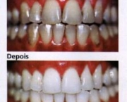 Clareamentos Dentarios (6)