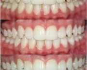 Clareamentos Dentarios (12)