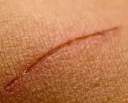 Como Tirar Cicatrizes e Marcas do Corpo (18)