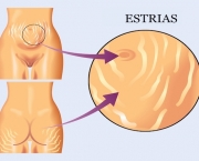 Estrias (1)