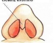 Exorrinoplastia (3)