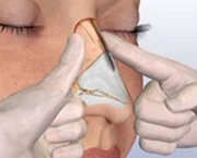 Fratura nasal (1)