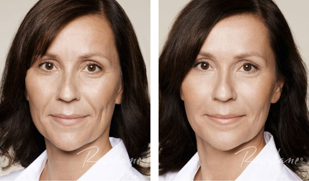 Skinbooster Area Dos Olhos Antes E Depois - Sobre os Olhos