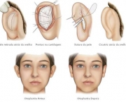 otoplastia-cirurgia-da-orelha (9)