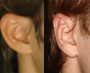 otoplastia-cirurgia-da-orelha (10)