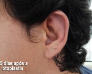 otoplastia-cirurgia-da-orelha (12)