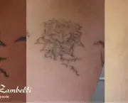 Remoção de Tatuagens (1)