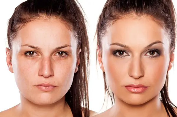 Antes e Depois do Botox